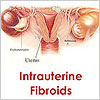 Intrauterine Fibroids